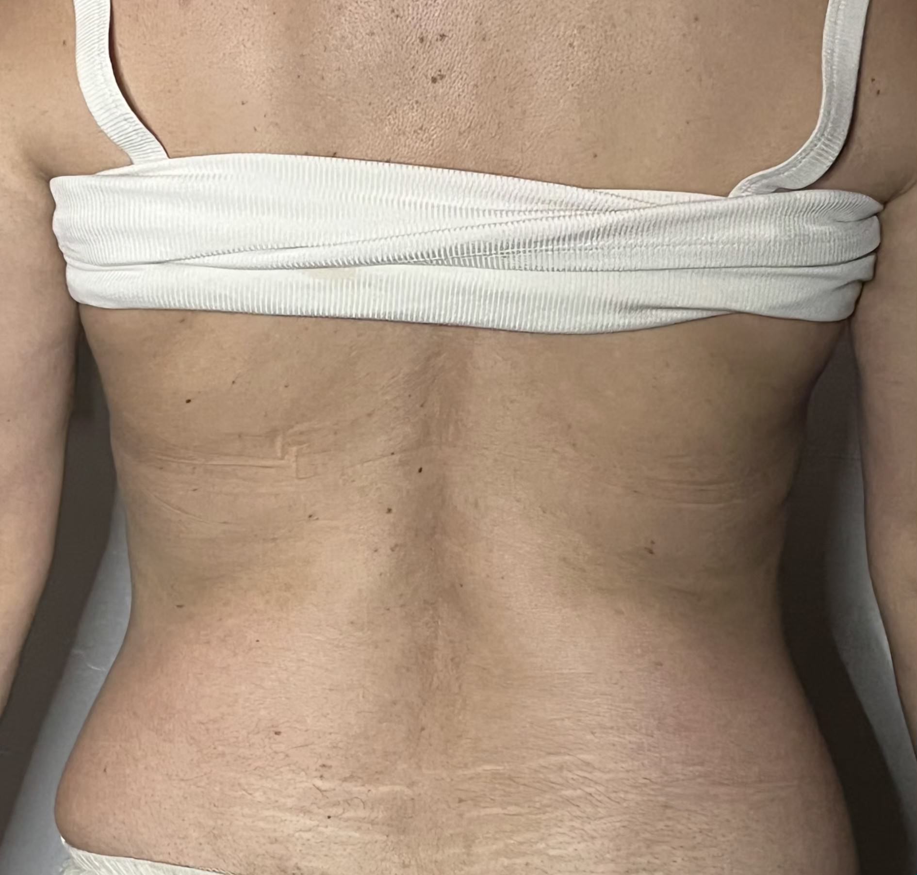 Ultrasonic cavitation and RF body contouring — results after 1 session, Refined Comfort Aesthetics New Braunfels TX
