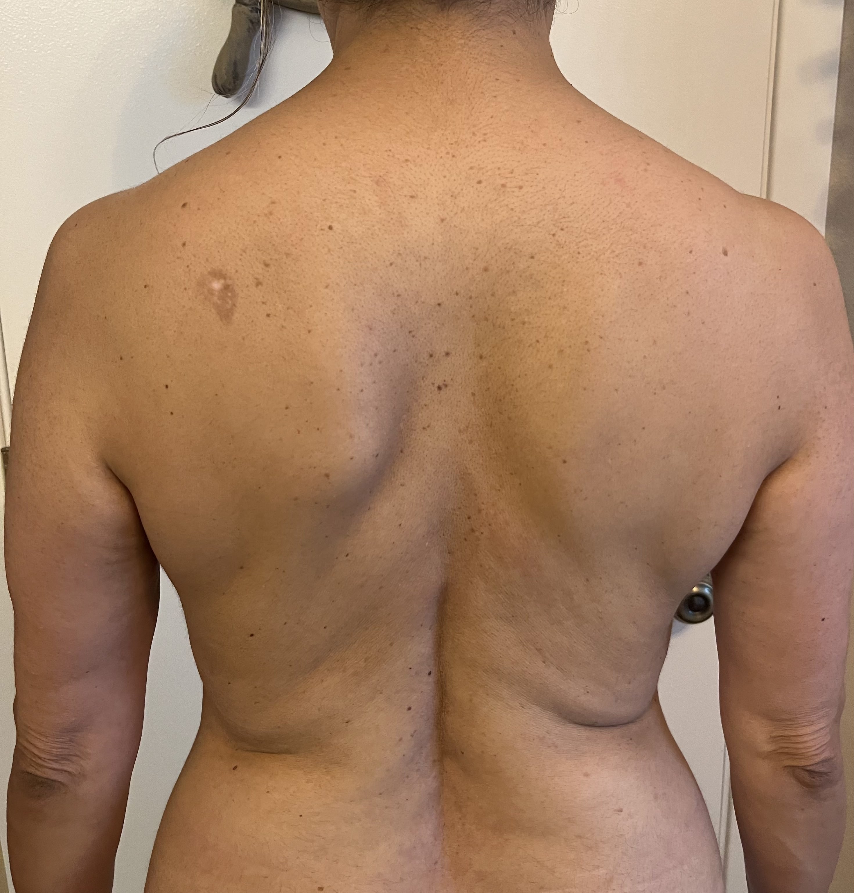 Ultrasonic cavitation and RF body contouring — before treatment, Refined Comfort Aesthetics New Braunfels TX